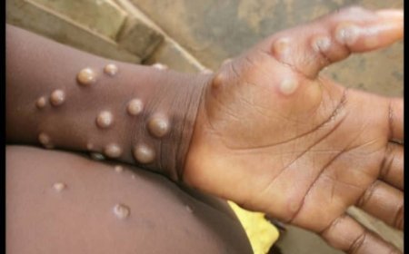 Mpox : Deux cas confirmés dans la province du Haut-katanga
