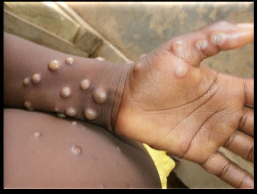 Mpox : Deux cas confirmés dans la province du Haut-katanga