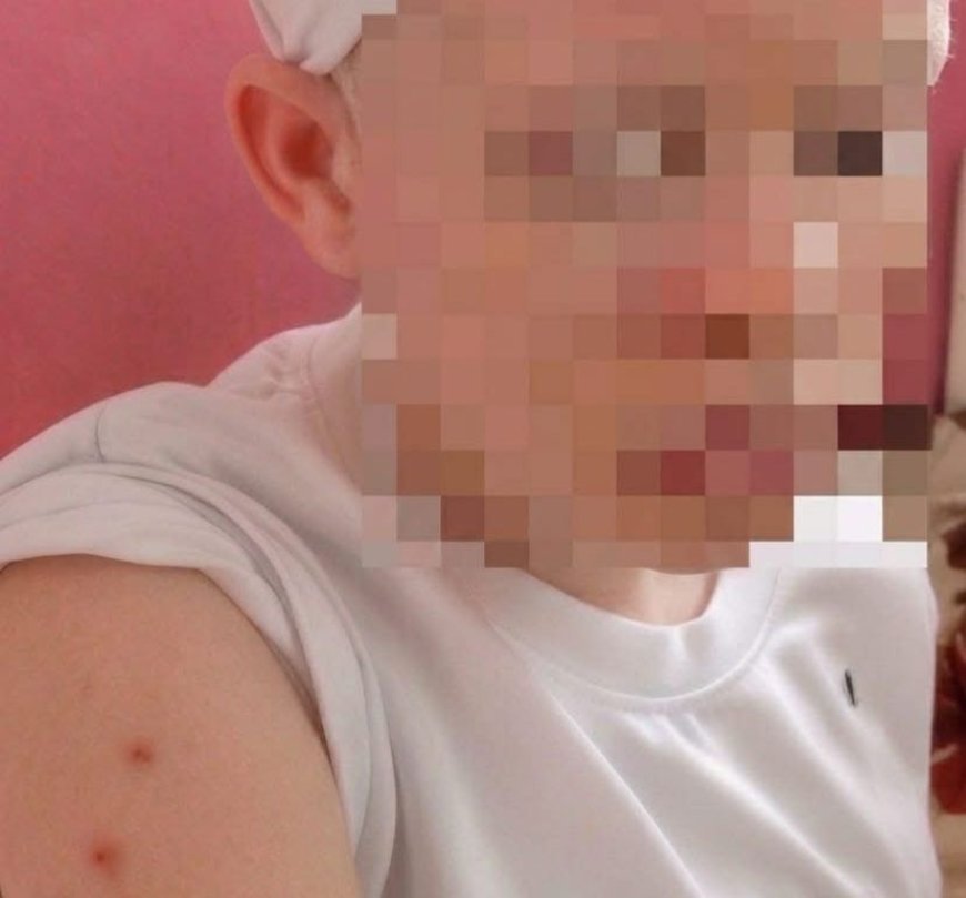 Maniema : Une adolescente atteinte d’albinisme victime d’une agression barbare à Kindu