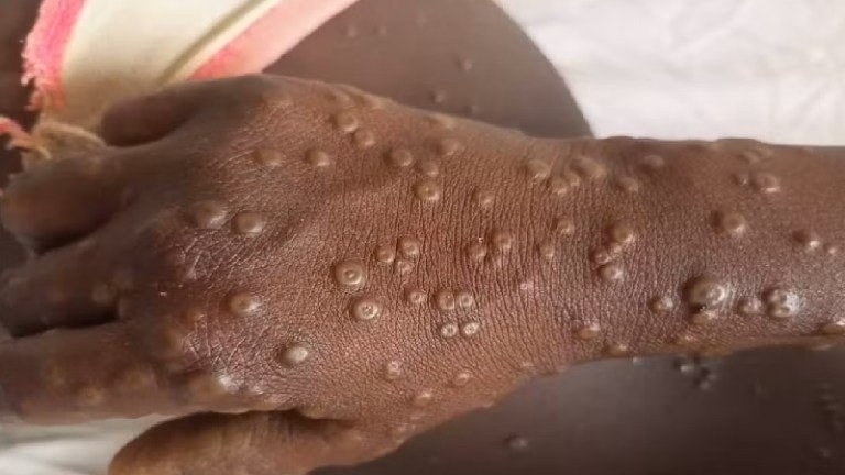 Kenya: Africa CDC déclare une urgence de santé publique face à la flambée de Mpox