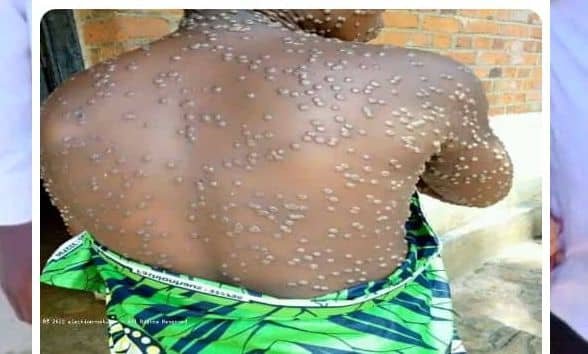 TANGANYIKA : Un cas suspect de mpox détecté dans le territoire de Manono