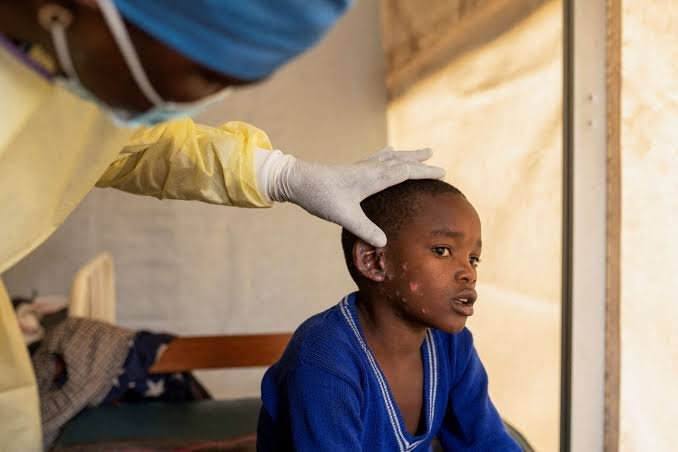 Mpox : la promiscuité dans les camps de déplacés, un facteur aggravant la contamination